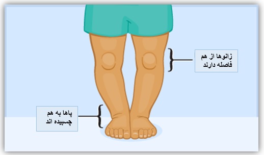 درمان پای پرانتزی (Genu Varum) 