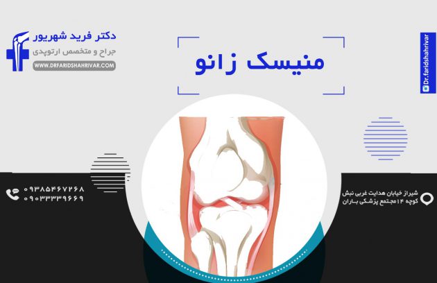 درمان منیسک زانو در شیراز