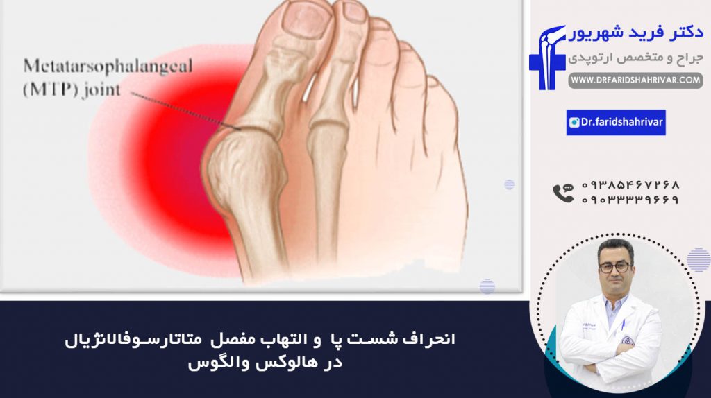 انحراف شست پا  و التهاب مفصل  متاتارسوفالانژیال  