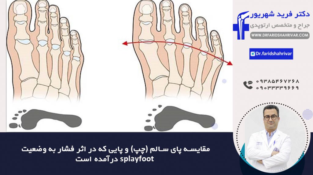 splayfoot 