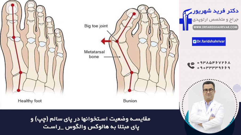 مقایسه وضعیت استخوانها در پای سالم (چپ) و پای مبتلا به هالوکس والگوس (راست)