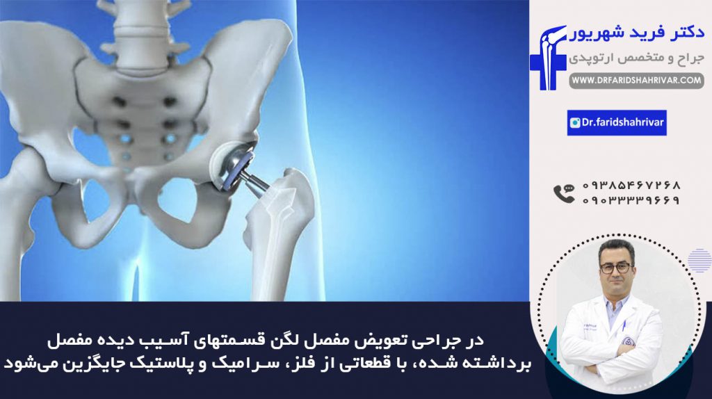 جراحی تعویض مفصل لگن در شیراز