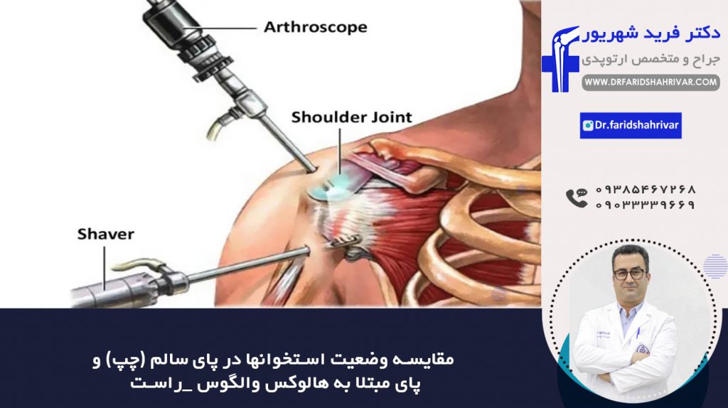 آرتروسکوپی شانه shoulder-arthroscopy در شیراز