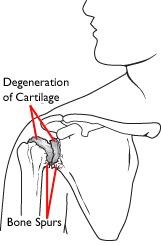 تخریب غضروف (Degeneration of Cartilage) و خارهای استخوانی 