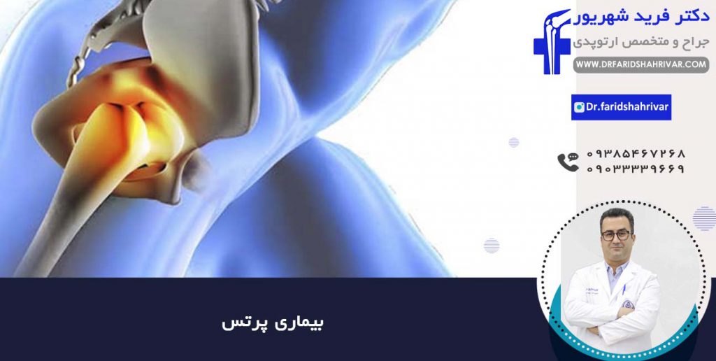 درمان بیماری پرتس در شیراز