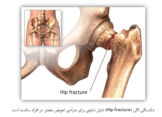 شکستگی لگن (Hip fracture) 