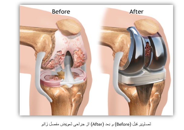 تصاویر قبل (Before) و بعد (After) از جراحی تعویض مفصل زانو